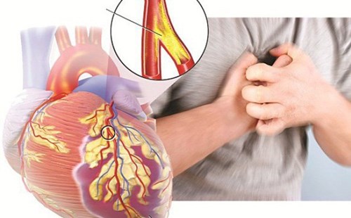 Ho, đau ngực, khó thở khi gắng sức… là triệu chứng của suy tim
